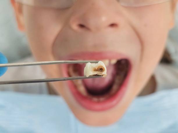 Best Emergency Tooth Extraction in Combined Locks, WI